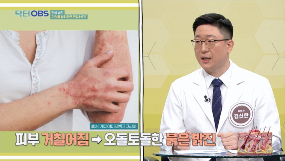 당산역피부과 건선, 광선치료만으로 좋아질 수 있을까요? 관련 이미지 3