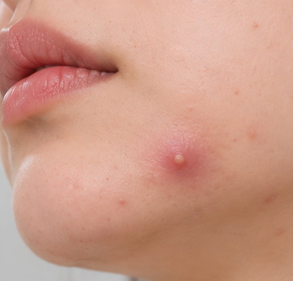 대방역피부과 여드름 치료, 같은 자리에 크고 아픈 염증이 반복되는 이유는 무엇일까요? 관련 이미지 2