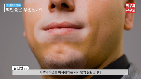 얼굴백반증 치료 병원, 절대 놓치면 안 되는 관련 이미지 4