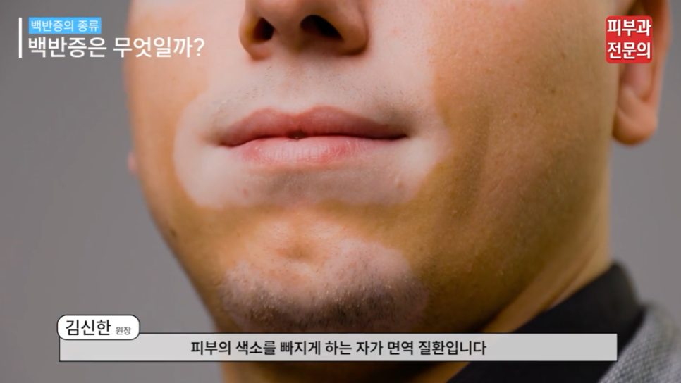 피부 백반증연고 치료, 면역 체계에 접근해야 하는 이유! 관련 이미지 8