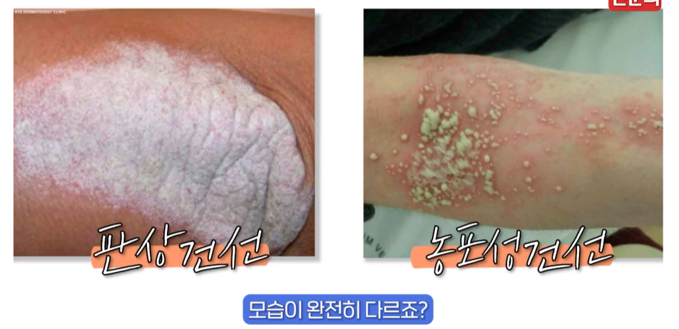 건선 광선치료 피부과, 안전한 결과를 기대하기 위해 꼭 기억해야 할 1가지 관련 이미지 4