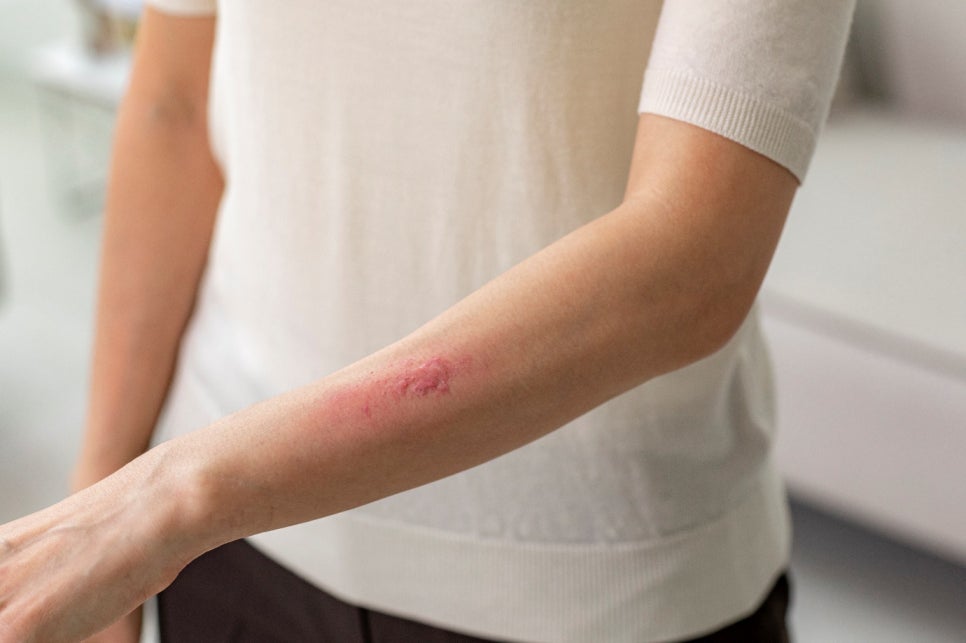 서울 아토피/건선 치료병원 추천, 가려움증 때문에 고민이라면 꼭 보세요. 관련 이미지 3