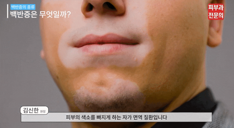 문래역피부과 백반증 엑시머 레이저 치료, 효과 높이려면 관련 이미지 4