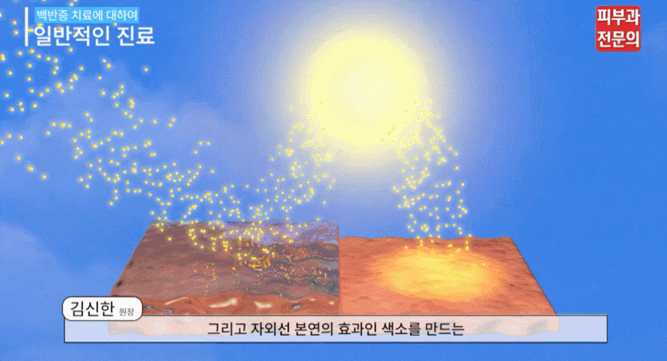 장승배기역 피부과 백반증 증상, 초기 변화부터 치료 방향까지 말씀드립니다. 관련 이미지 5