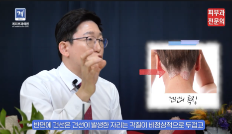 피부건선치료 방법 이 글 하나로 정리해 드립니다. (피부과 전문의 작성) 관련 이미지 5