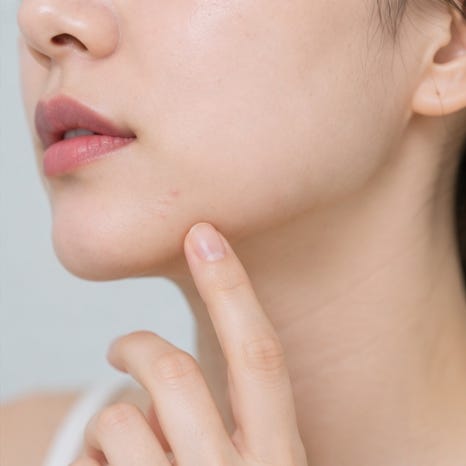 오목교역피부과 여드름 압출치료, 좁쌀여드름이 염증성으로 변하기 전에 관리해야 할까요? 관련 이미지 3