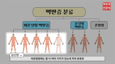 피부흰색반점 치료 백반증? 피부과 전문의가 말하는 핵심 관련 이미지 3
