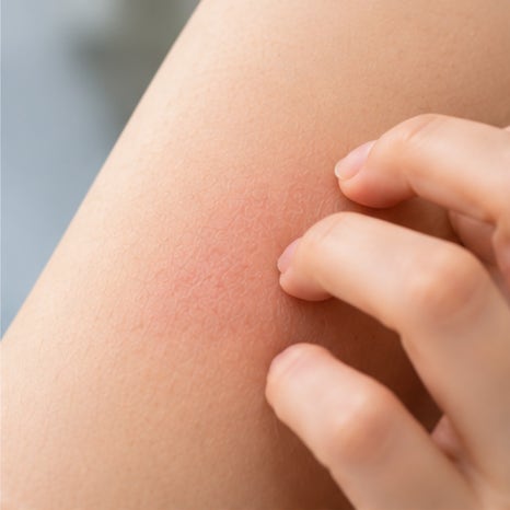 영등포역피부과 건선 치료, 피부를 긁거나 상처가 난 자리에 새로운 건선이 생길 수 있을까요? 관련 이미지 2