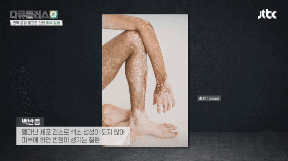 여의도역 성인백반증피부과, 계피부과 김중호 김신한 병원장 방송 출연 (JTBC 다큐플러스Q) 관련 이미지 3