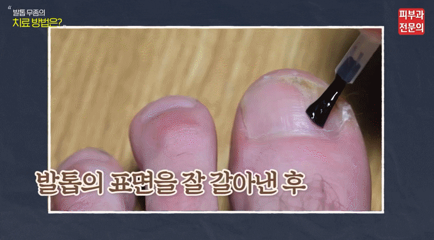 노량진역피부과 추천? 전문의가 말하는 발톱무좀 없애는 법 TOP3? 관련 이미지 2