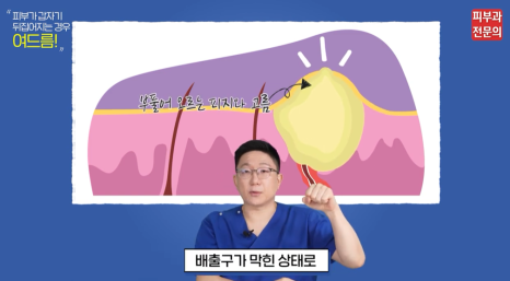대림동피부과 여드름치료 잘하는곳? 압출은 이렇게 해야 합니다. 관련 이미지 3