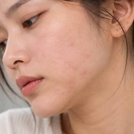 대방역피부과 여드름 치료, 같은 자리에 크고 아픈 염증이 반복되는 이유는 무엇일까요? 관련 이미지 4