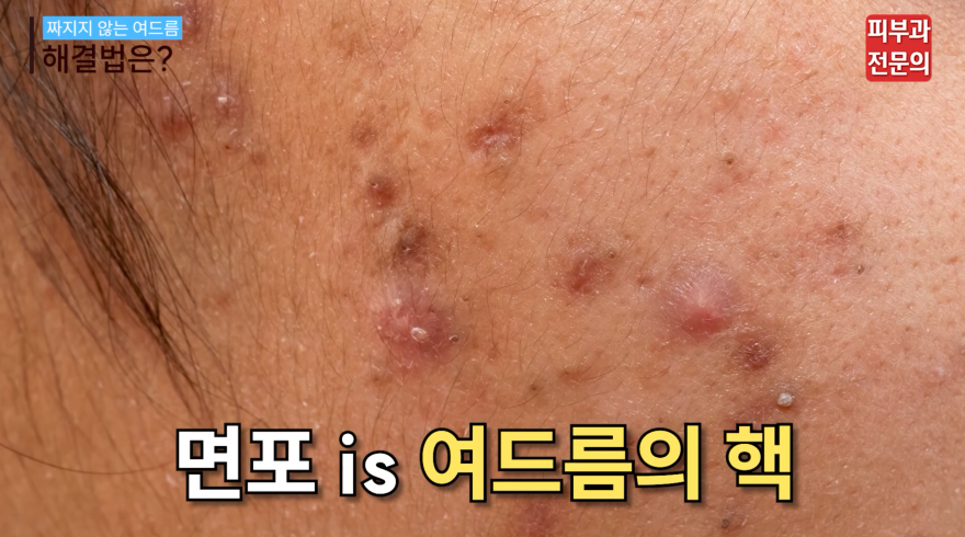 서울 화농성여드름피부과 추천, 치료 전 꼭 알아두셔야 할 것 관련 이미지 8