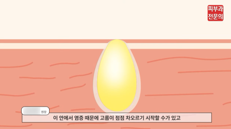염증성여드름치료 피부과, 관리에 힘써야 하는 이유? 관련 이미지 4