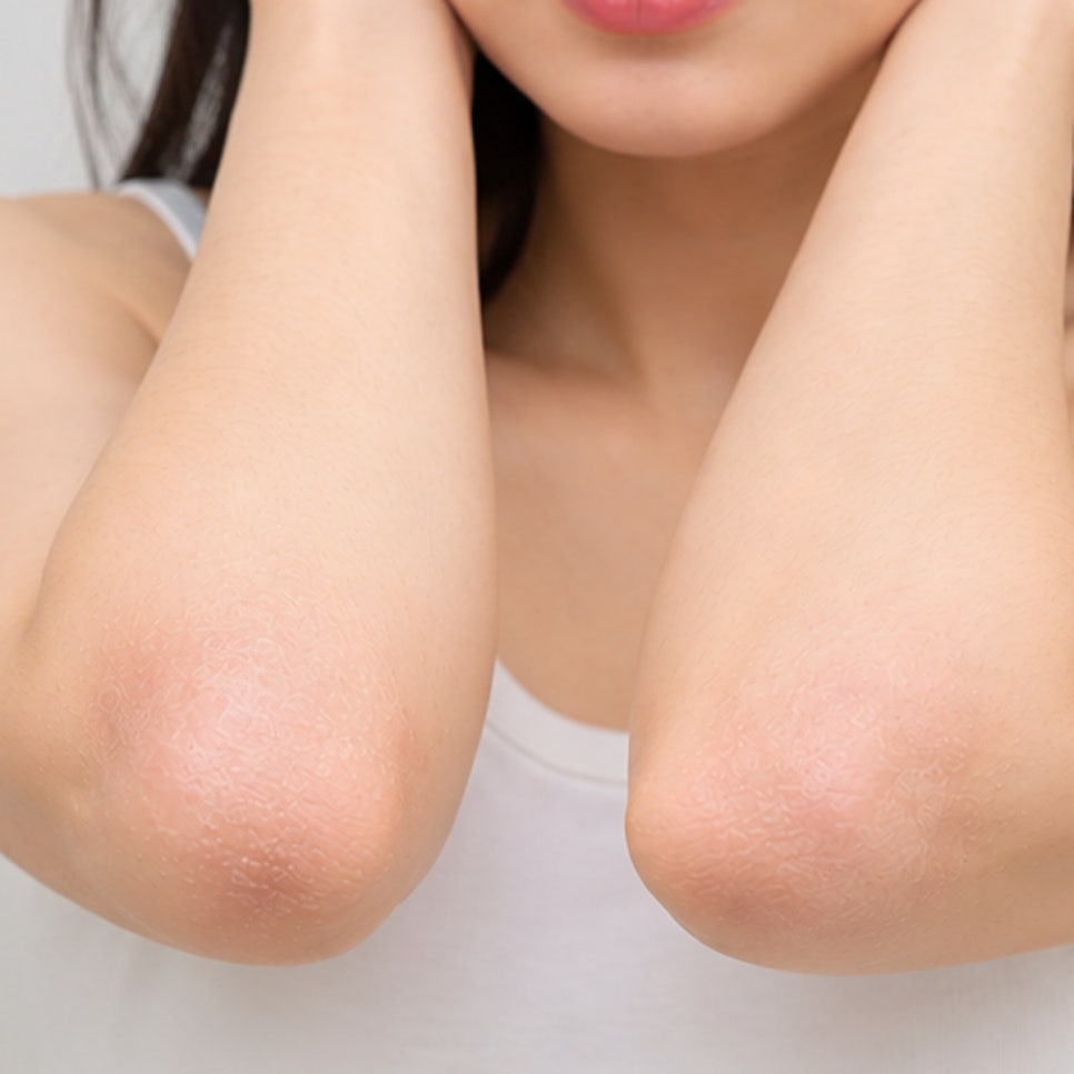 서울 건선치료잘하는곳 추천, 연고를 발라도 각질과 붉은기 증상이 반복되는 이유는? 관련 이미지 1