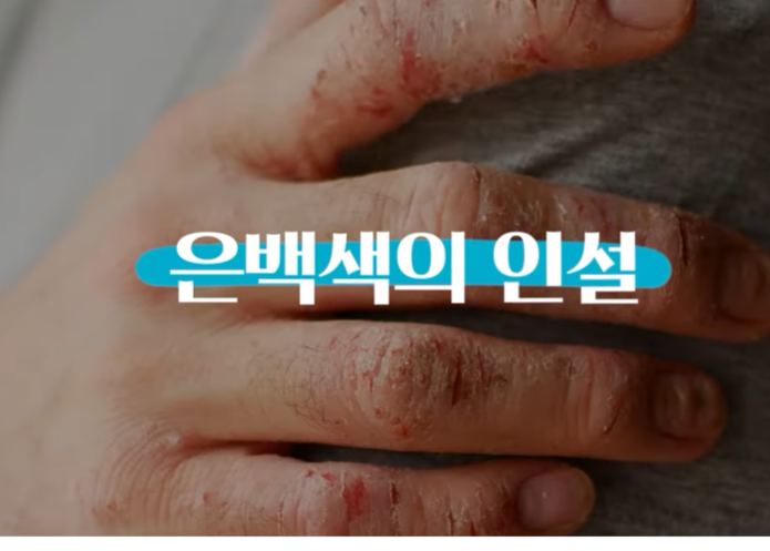 영등포건선 치료, 재발 방지를 위해 기억해야 할 핵심 관련 이미지 4
