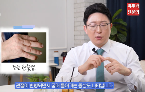 피부 건선치료법, 피부과 전문의가 정리해 드립니다. 관련 이미지 7