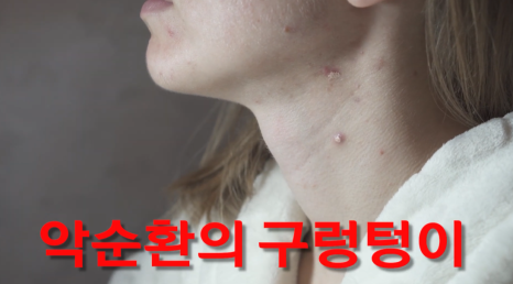 얼굴여드름치료 병원, 막힌 모공을 여는 열쇠 관련 이미지 3