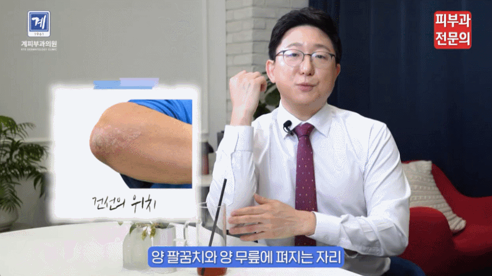 문래역피부과 추천 건선 치료, &lsquo;이것&rsquo; 절대 놓치면 절대 안 됩니다. 관련 이미지 5