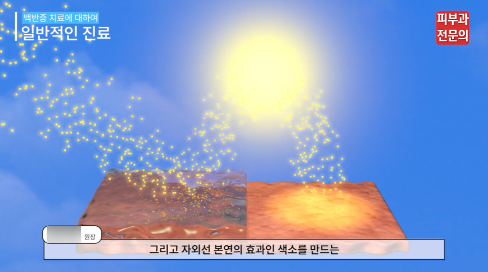 피부백반증치료 방법, 이것만 꼭 살펴보세요. 관련 이미지 5