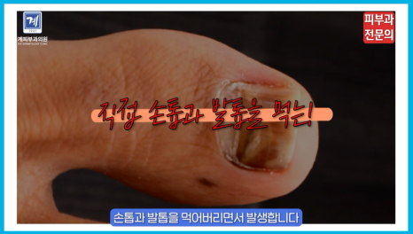 건선연고 치료 피부과 : 사용 성분, 제대로 알고 치료하셔야 합니다. 관련 이미지 4