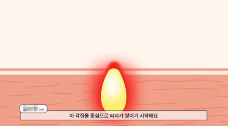 샛강역피부과, 여드름 피지선 레이저 치료 아프지는 않을까? 관련 이미지 2