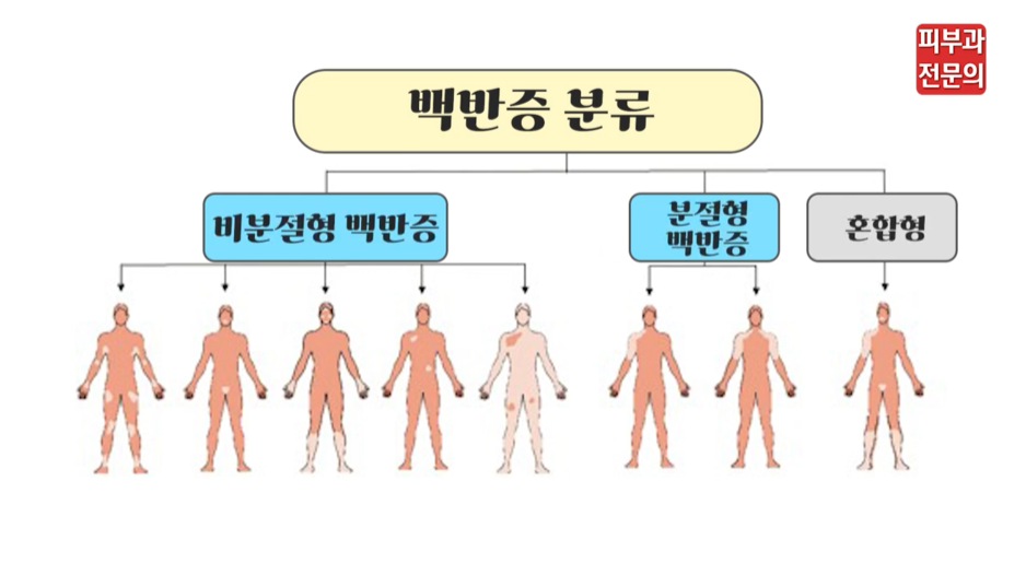 샛강역피부과 백반증에도 종류가 있다? <대공개> 관련 이미지 5