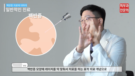 신길역피부과 백반증 레이저 치료 전 꼭 알아 두어야 할 관련 이미지 6