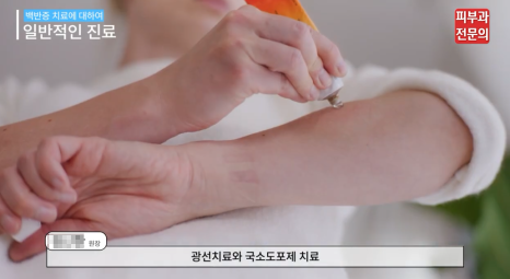 백반증약 처방 병원, 면역억제연고 치료에 대한 정보 관련 이미지 9