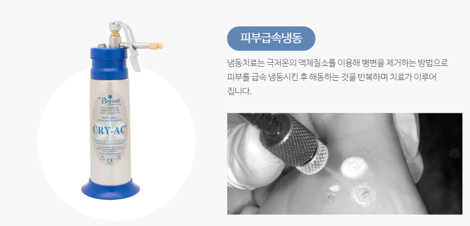 구로디지털피부과 잘하는곳? 사마귀냉동치료 통증에 대한 정보 관련 이미지 6