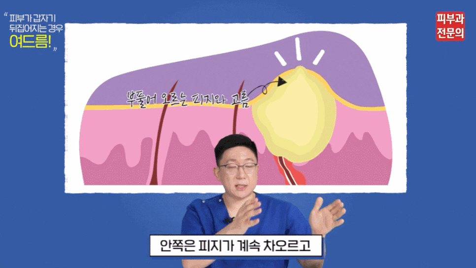 영등포역 여드름 흉터 레이저 피부과, 색소침착과 패인 흉터를 치료해야 하는 이유 관련 이미지 2
