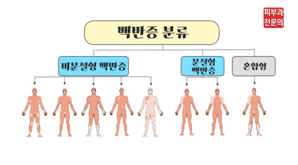 전신백반증 피부과 전문의가 말하는 치료 목적! 관련 이미지 3