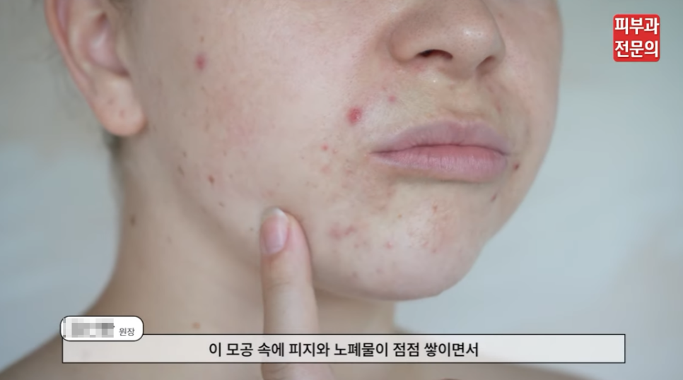 여드름스케일링 피부과, 환자별로 다르게 진행되어야 하는 이유 관련 이미지 1