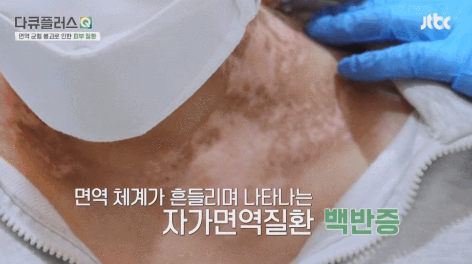 여의도역 성인백반증피부과, 계피부과 김중호 김신한 병원장 방송 출연 (JTBC 다큐플러스Q) 관련 이미지 5