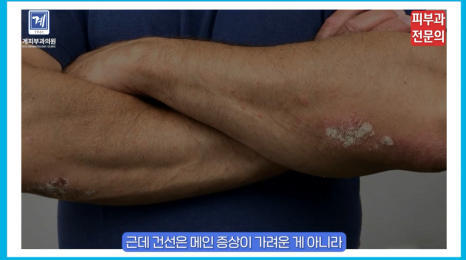 피부건선치료 방법 이 글 하나로 정리해 드립니다. (피부과 전문의 작성) 관련 이미지 4