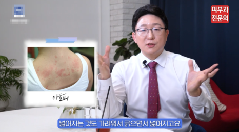 양평역피부과 추천, 건선 그대로 두면 안 되는 이유 관련 이미지 6