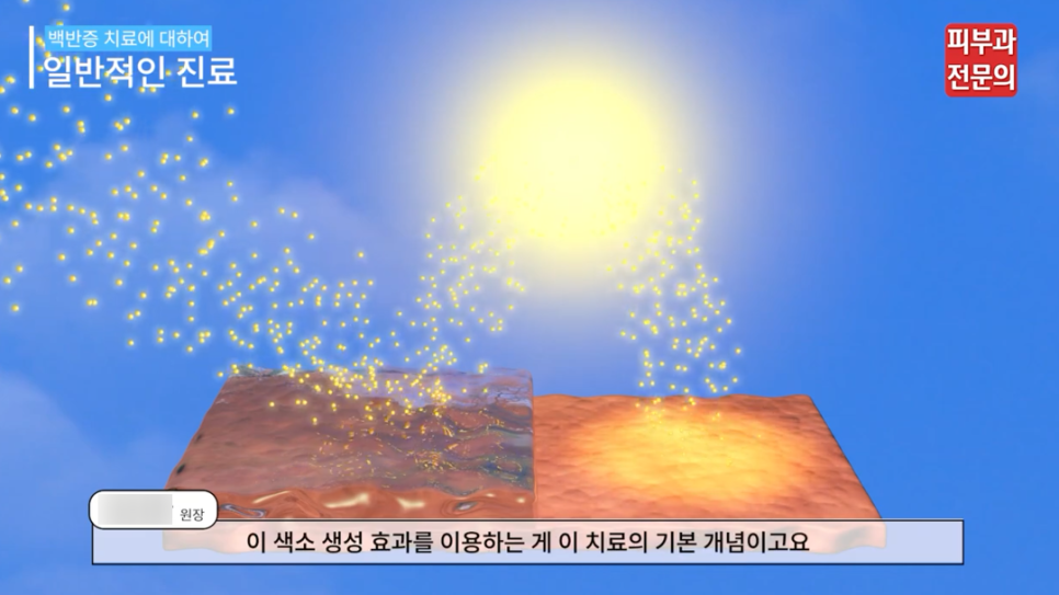 신길역피부과 백반증 레이저 치료 전 꼭 알아 두어야 할 관련 이미지 5