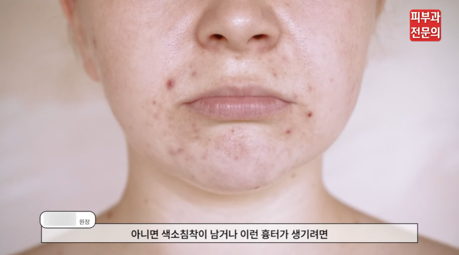 서울 여드름흉터제거 피부과, 색소침착 함몰흉터 치료 방법은? 관련 이미지 5