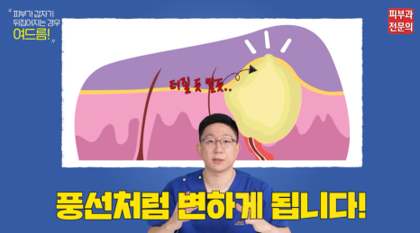 대림동피부과 여드름치료 잘하는곳? 압출은 이렇게 해야 합니다. 관련 이미지 4