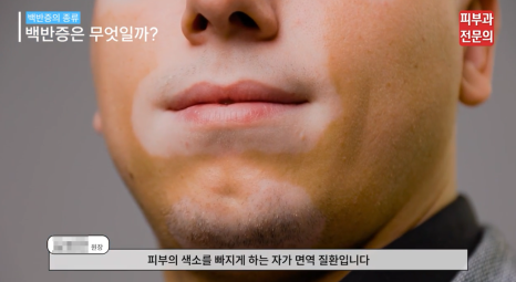 백반증약 처방 병원, 면역억제연고 치료에 대한 정보 관련 이미지 3