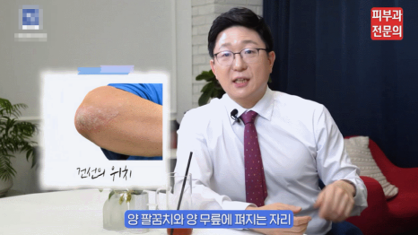 피부 건선연고 치료 어떤 성분을 통해 진행되나요? <피부과 전문의 작성> 관련 이미지 5