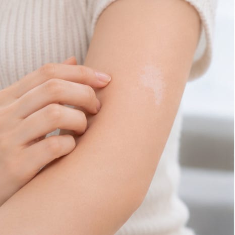 샛강역피부과 백반증 증상, 흰 반점의 경계가 점점 넓어지는 것 같다면 무엇을 확인해야 할까요? 관련 이미지 3