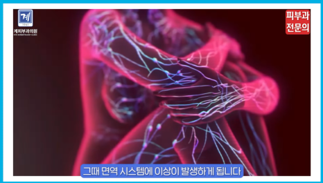 피부과 전문의가 말하는 건선치료법 추천, 연고 & 광선 치료에 대한 정보! 관련 이미지 3