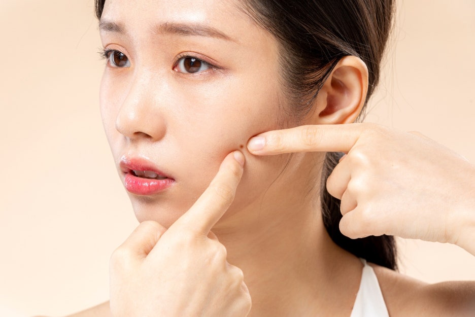 타임스퀘어피부과 추천, 여드름 똑똑하게 관리하고 싶으시다면 꼭 읽어보세요. 관련 이미지 4