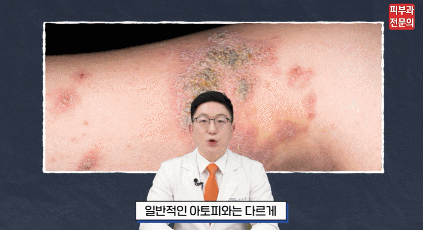보라매역피부과 아토피 증상, 연고 치료와 함께 필요한 필요한 피부 관리 안내 관련 이미지 1