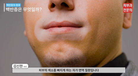 양평역피부과 잘하는곳 백반증 치료를 위한 조언 (피부과 전문의 작성) 관련 이미지 4