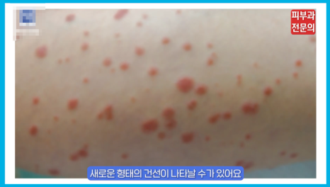 판상 물방울건선 치료 피부과, 이것 모르면 절대 안 됩니다! 관련 이미지 2