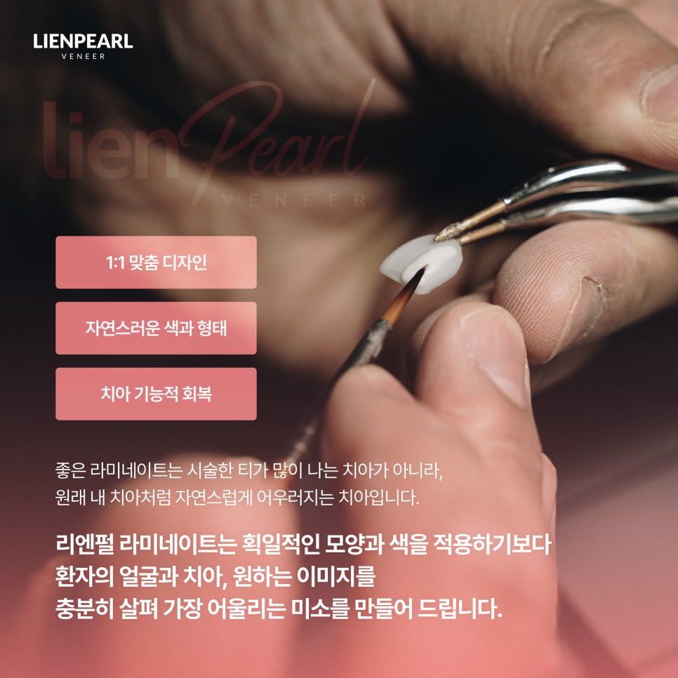 Rien Pearl Veneers: A Choice for a Natural Smile That Lasts Over Time image 7