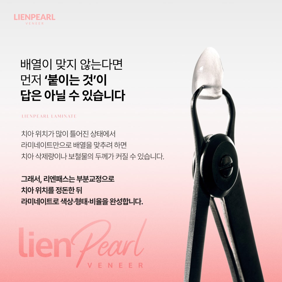 앞니 라미네이트, 치아 모양과 배열에 따라 방법이 달라집니다! 관련 이미지 5