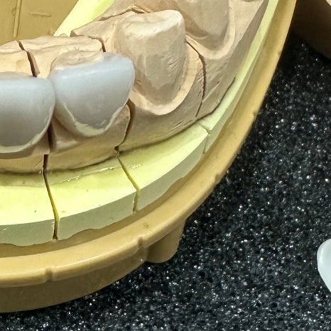 치과보철물 종류별 가격과 특징 관련 이미지 7